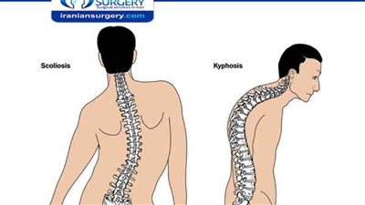 تعرف على أسباب إنحناء العمود الفقري.. وكيفية معالجته| فيديو