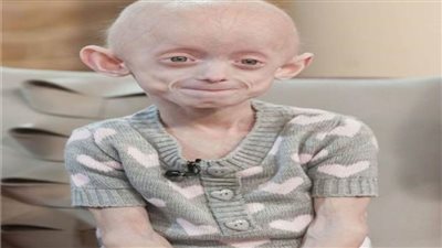 من شيخوخة الأطفال إلى متلازمة ستونمان.. أغرب الأمراض حول العالم 