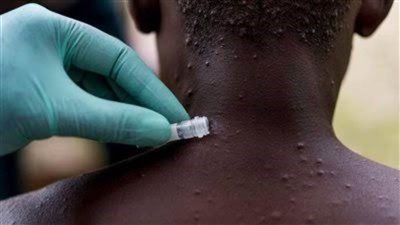 هولندا تعلن تسجيل إصابات جديدة بمرض جدري القرود