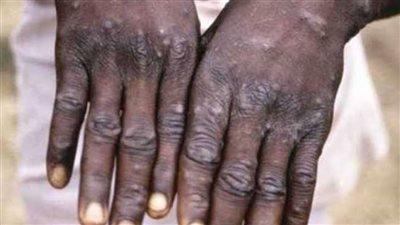 النمسا تعلن أول إصابة مؤكدة بـ جدري القرود