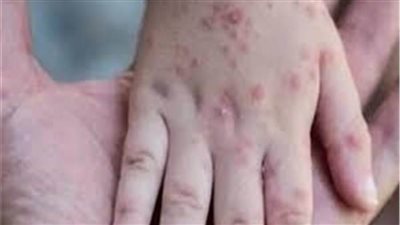 الهند تسجل إرتفاع جديد في جدري القردة 