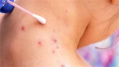 الهيئة الأوروبية للأدوية: لقاح امفانكس للوقاية من جدري القرود ليس تجريبيا 