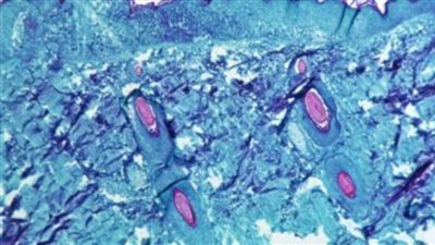 المصل واللقاح يكشف حقائق هامة حول مرض جدرى القرود.. اعرف التفاصيل