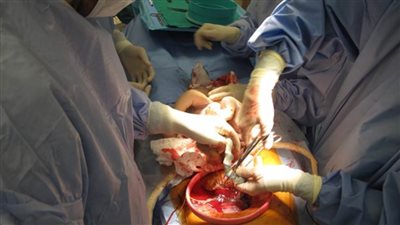 بعد المعدلات الخطرة.. مصر تتوسع في إطلاق حملات توعية للحد من الولادات القيصرية