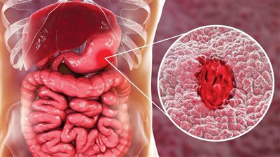 احذر الإصابة بجرثومة المعدة: قد تسبب أوراما خبيثة