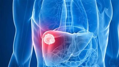 مساعد وزير الصحة: انخفاض نسب اكتشاف الحالات المتأخرة بسرطان الكبد إلى 14%