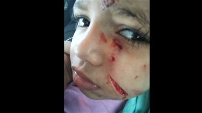 كلب ضال يعقر طفلة بحدائق الأهرام ويشوه وجهها.. والأسرة تناشد إنقاذها وإجراء جراحة تجميلية